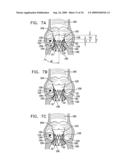 VALVE SUTURING AND IMPLANTATION PROCEDURES diagram and image