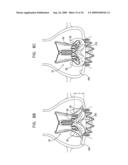 VALVE SUTURING AND IMPLANTATION PROCEDURES diagram and image