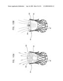 VALVE SUTURING AND IMPLANTATION PROCEDURES diagram and image