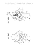 VALVE SUTURING AND IMPLANTATION PROCEDURES diagram and image