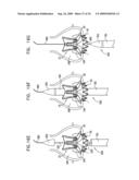 VALVE SUTURING AND IMPLANTATION PROCEDURES diagram and image