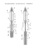 VALVE SUTURING AND IMPLANTATION PROCEDURES diagram and image