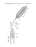 VALVE SUTURING AND IMPLANTATION PROCEDURES diagram and image