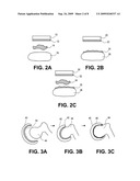 Methods, Devices and Compositions for Adhering Hydrated Polymer Implants to Bone diagram and image