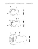 Methods, Devices and Compositions for Adhering Hydrated Polymer Implants to Bone diagram and image