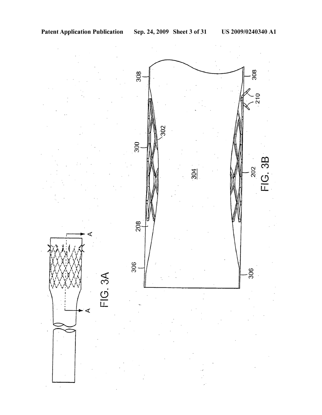 Bariatric sleeve - diagram, schematic, and image 04