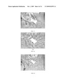 COMPRESSION STOCKING APPLICATOR diagram and image