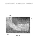 COMPRESSION STOCKING APPLICATOR diagram and image