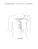 CEREBRAL PERFUSION AUGMENTATION diagram and image