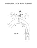 CEREBRAL PERFUSION AUGMENTATION diagram and image