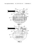 Wireless Implantable Medical Device diagram and image