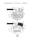 Wireless Implantable Medical Device diagram and image