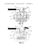 Wireless Implantable Medical Device diagram and image