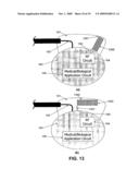 Wireless Implantable Medical Device diagram and image