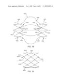 Double-Walled Stent System diagram and image