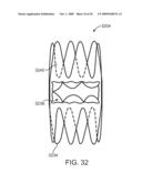 Double-Walled Stent System diagram and image