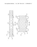 Double-Walled Stent System diagram and image