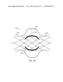 Double-Walled Stent System diagram and image