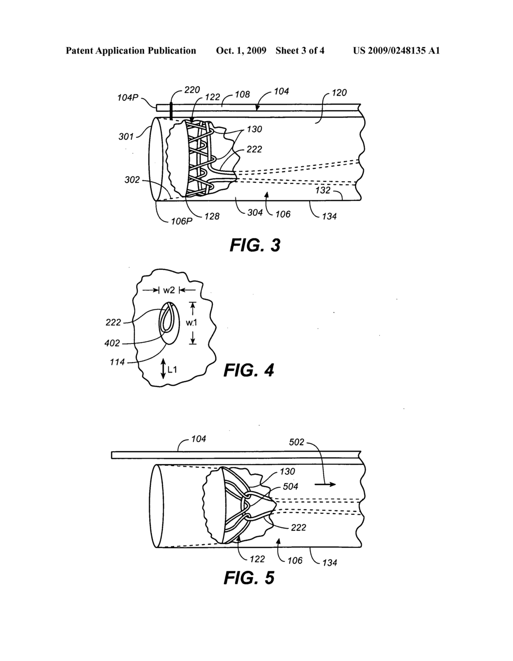 Eversible Branch Stent-Graft and Deployment Method - diagram, schematic, and image 04