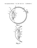 INTRAOCULAR LENS HAVING A HAPTIC THAT INCLUDES A CAP diagram and image