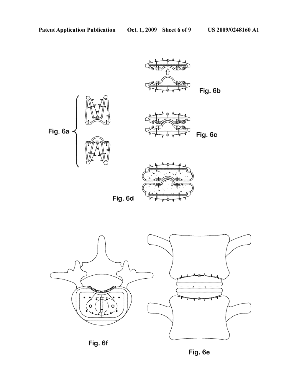 Inflatable Intervertebral Disc Replacement Prosthesis - diagram, schematic, and image 07