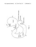 Bariatric sleeve diagram and image