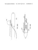 Bariatric sleeve diagram and image