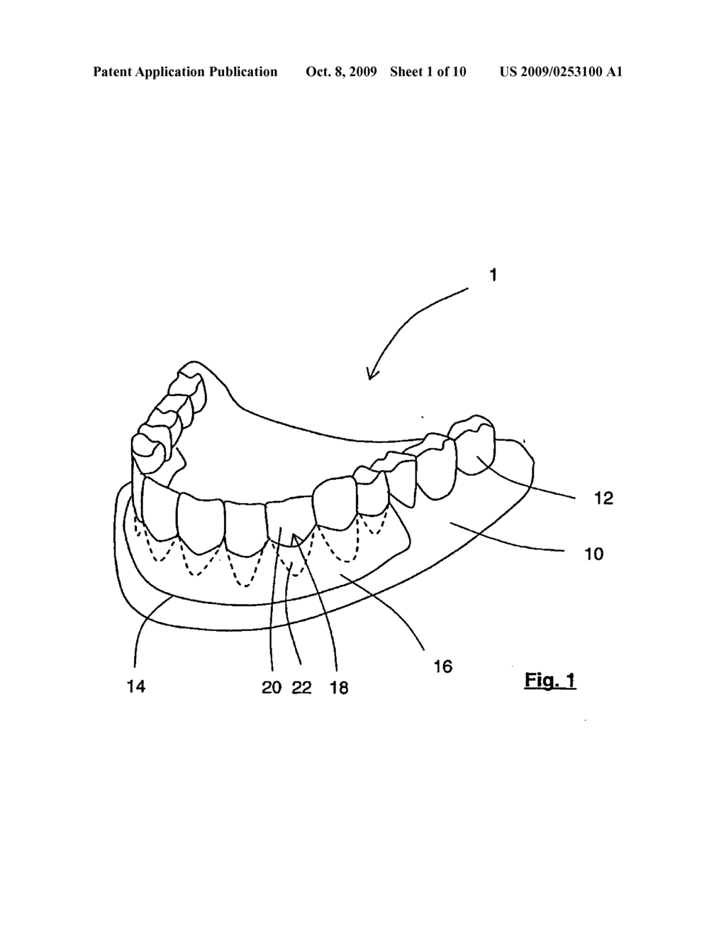 METHOD AND APPARATUS FOR MANUFACTURING ORTHODONTIC APPLIANCES - diagram, schematic, and image 02