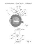 METHOD AND APPARATUS FOR SUTURELESS INJECTABLE RETINAL DETACHMENT SPONGE IMPLANTATION diagram and image