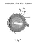 METHOD AND APPARATUS FOR SUTURELESS INJECTABLE RETINAL DETACHMENT SPONGE IMPLANTATION diagram and image