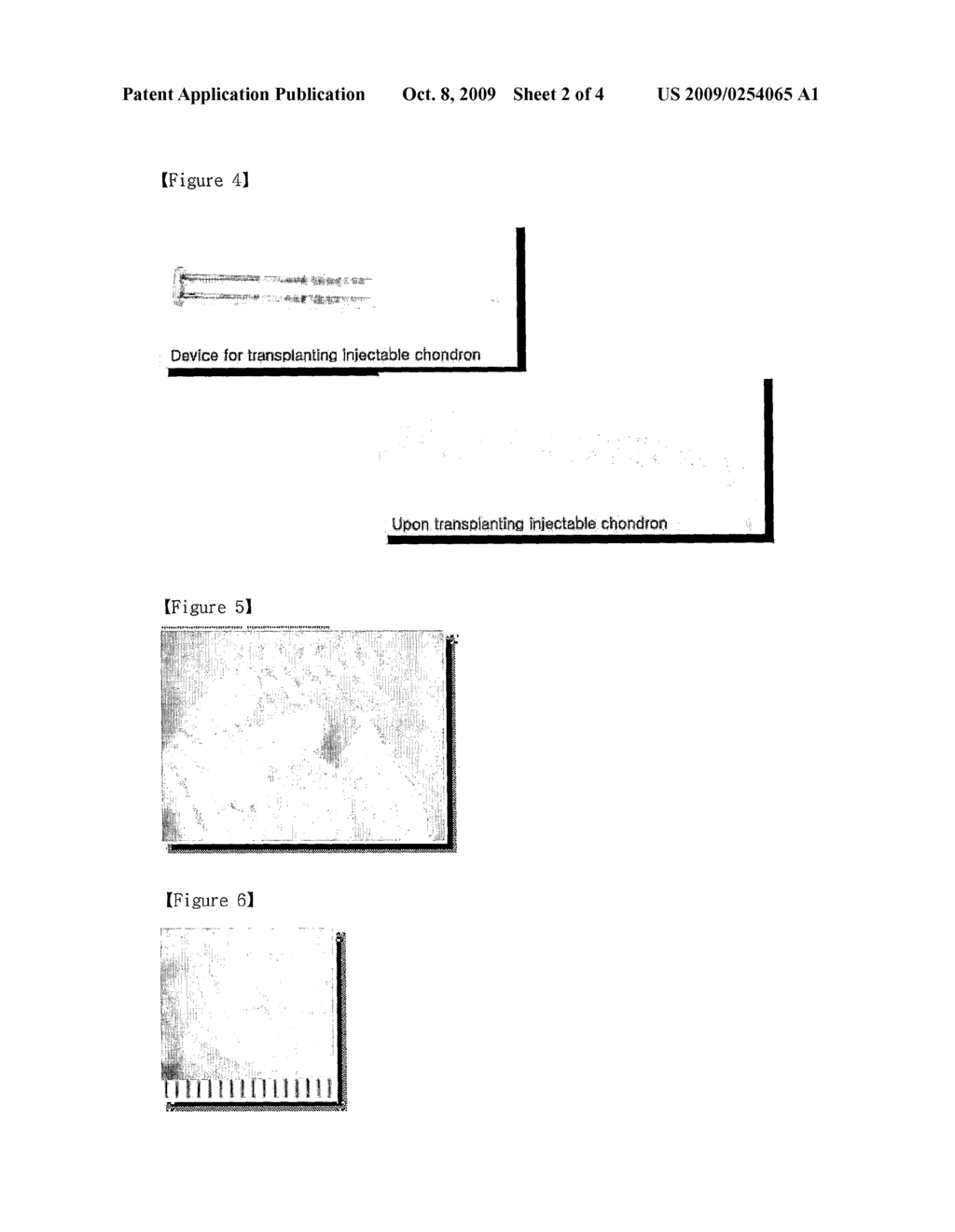 Simple method of transplanting injectable chordrocyte for autologous chondrocyte transplantation - diagram, schematic, and image 03