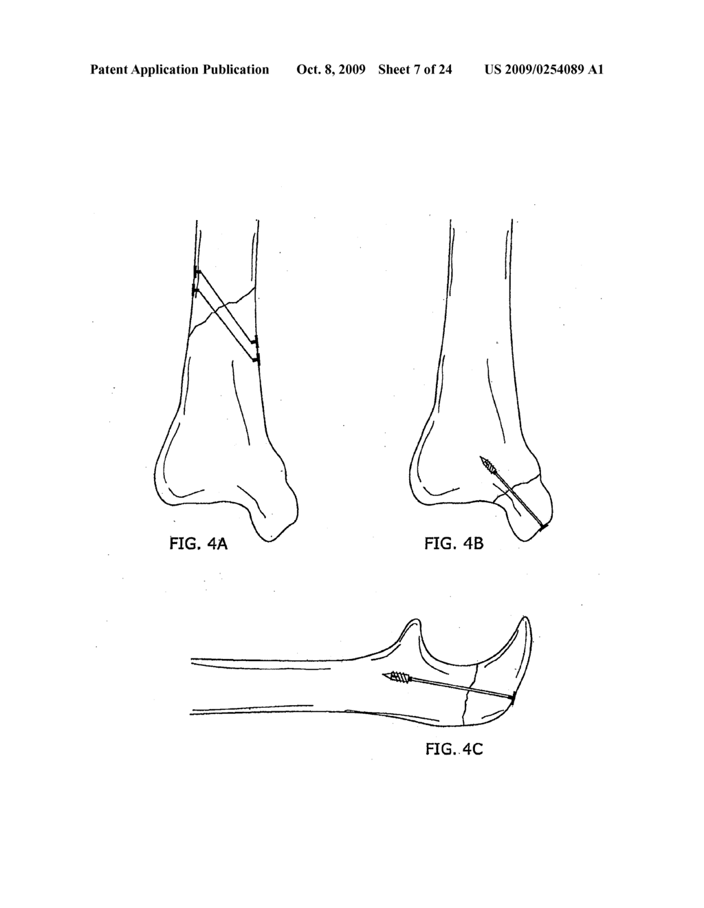 STABILIZATION SYSTEM AND METHOD FOR THE FIXATION OF BONE FRACTURES - diagram, schematic, and image 08