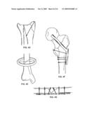 STABILIZATION SYSTEM AND METHOD FOR THE FIXATION OF BONE FRACTURES diagram and image