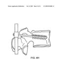 STABILIZATION SYSTEM AND METHOD FOR THE FIXATION OF BONE FRACTURES diagram and image