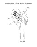 STABILIZATION SYSTEM AND METHOD FOR THE FIXATION OF BONE FRACTURES diagram and image