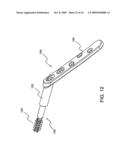 STABILIZATION SYSTEM AND METHOD FOR THE FIXATION OF BONE FRACTURES diagram and image