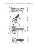 STABILIZATION SYSTEM AND METHOD FOR THE FIXATION OF BONE FRACTURES diagram and image