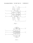 INTERSPINAL STABILIZATION SYSTEM diagram and image