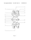 INTERSPINAL STABILIZATION SYSTEM diagram and image