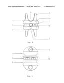 INTERSPINAL STABILIZATION SYSTEM diagram and image