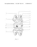 INTERSPINAL STABILIZATION SYSTEM diagram and image