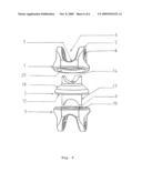 INTERSPINAL STABILIZATION SYSTEM diagram and image