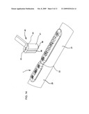 COMPRESSION/DISTRACTION OSTEOTOMY SYSTEM, PLATE, METHOD, DRILL GUIDE AND SAW GUIDE diagram and image