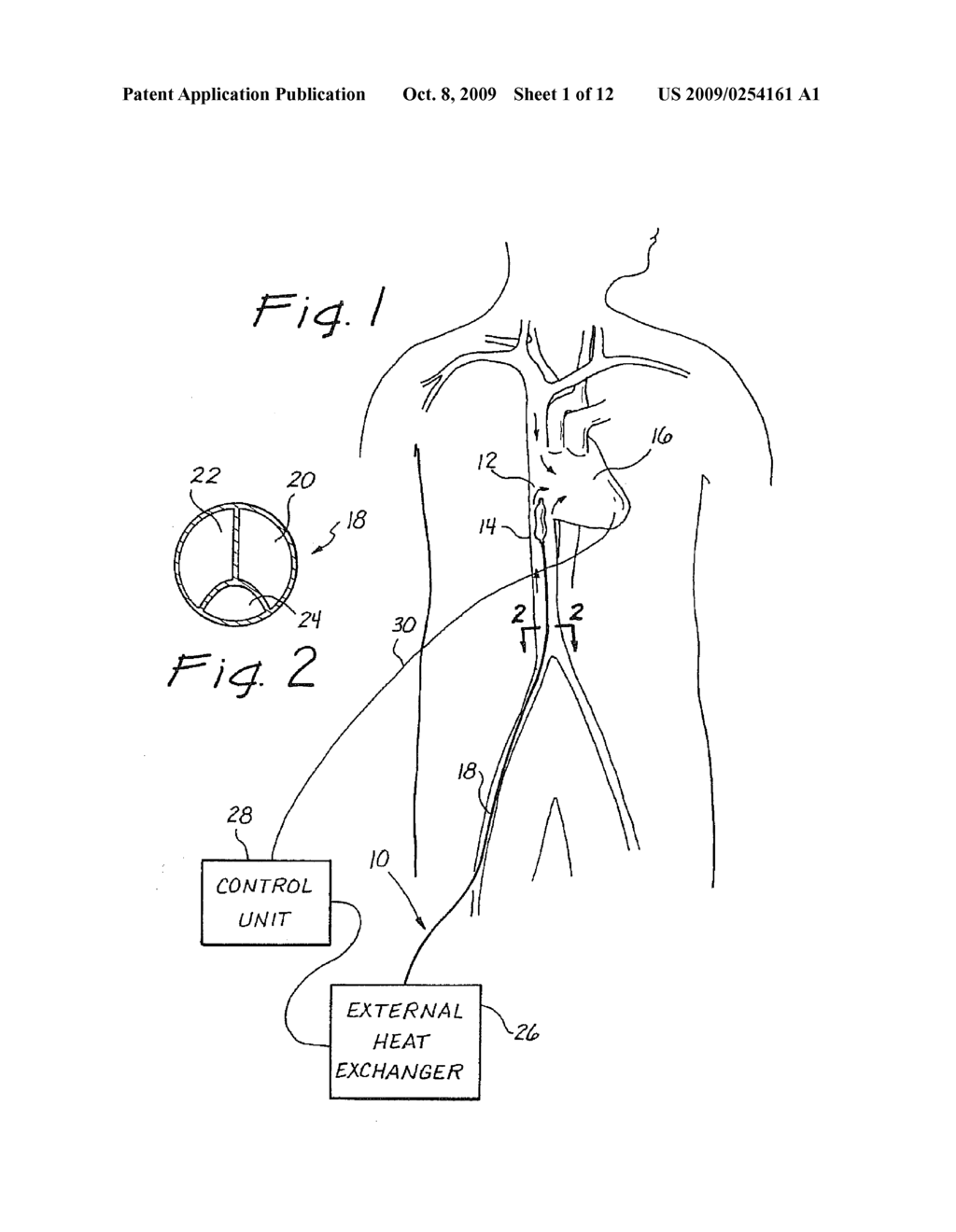 METHOD FOR REDUCING MYOCARDIAL INFARCT BY APPLICATION OF INTRAVASCULAR HYPOTHERMIA - diagram, schematic, and image 02