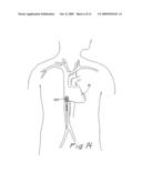 METHOD FOR REDUCING MYOCARDIAL INFARCT BY APPLICATION OF INTRAVASCULAR HYPOTHERMIA diagram and image