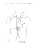 METHOD FOR REDUCING MYOCARDIAL INFARCT BY APPLICATION OF INTRAVASCULAR HYPOTHERMIA diagram and image