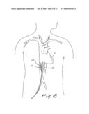 METHOD FOR REDUCING MYOCARDIAL INFARCT BY APPLICATION OF INTRAVASCULAR HYPOTHERMIA diagram and image