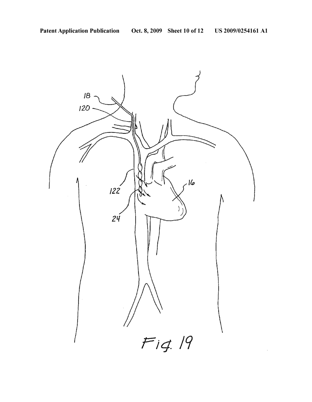 METHOD FOR REDUCING MYOCARDIAL INFARCT BY APPLICATION OF INTRAVASCULAR HYPOTHERMIA - diagram, schematic, and image 11