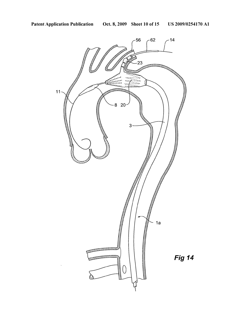 Branch stent graft deployment and method - diagram, schematic, and image 11