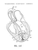 SYSTEM FOR IMPROVING CARDIAC FUNCTION BY SEALING A PARTITIONING MEMBRANE WITHIN A VENTRICLE diagram and image